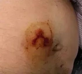 凌晨3點(diǎn) 一排綠色蟲(chóng)卵在我身上孵出14個(gè)崽！