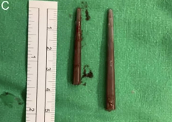 從腦袋里拔出了一雙筷子：你永遠(yuǎn)猜不到醫(yī)生能從患者身上找到什么