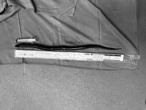 醫(yī)生從患者肚子里扯出一條活鰻魚(yú) 這不比異形還刺激