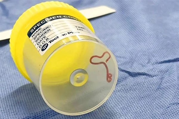 世界首例！人腦中發(fā)現(xiàn)長達(dá)8厘米的蛔蟲：和吃有關(guān)