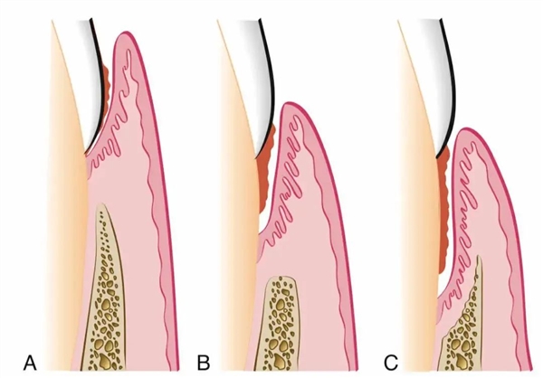 一種會讓牙齒掉光的病 很多人年輕時不重視