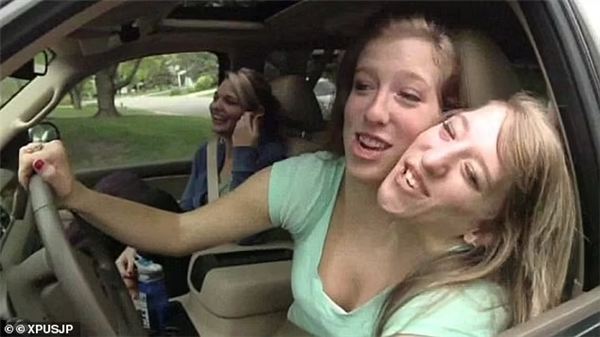 美國著名連體雙胞胎共享身體 一個已婚想生孩子 另一個咋辦