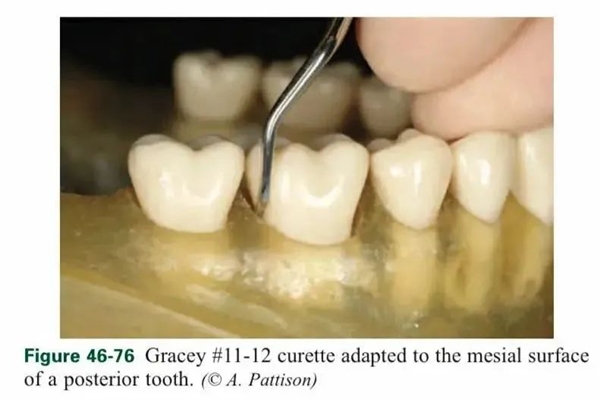 一種會讓牙齒掉光的??！很多人年輕時都不重視