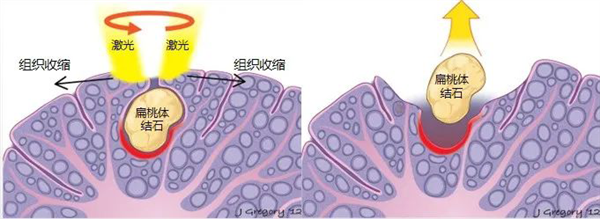 慎入！口腔內(nèi)長(zhǎng)出“玉米?！?捏扁了還臭臭的 到底是啥