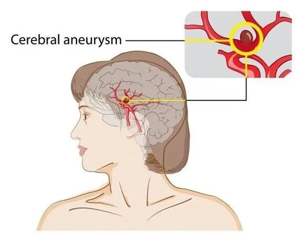 知名男歌手臺上高歌致腦出血不幸離世！這類人唱歌千萬要小心