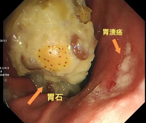 男子山楂和栗子一起吃 胃里長(zhǎng)出8厘米石頭