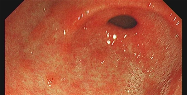 2個人中就有1人感染：醫(yī)生讓查幽門螺旋桿菌是真的想救你！