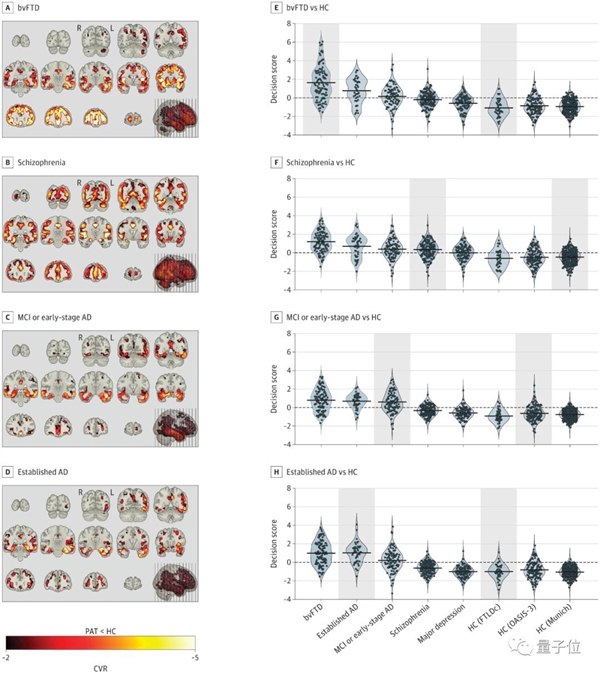 科學(xué)家用ML證明120年前爭議理論：精神分裂與癡呆癥存在相似之處
