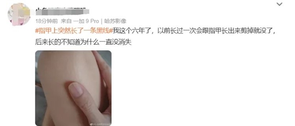指甲出現(xiàn)一條黑線 別不當(dāng)回事！可能是癌變