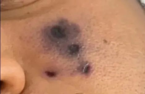 28歲歌手突然去世：只因被蜘蛛咬傷了臉！