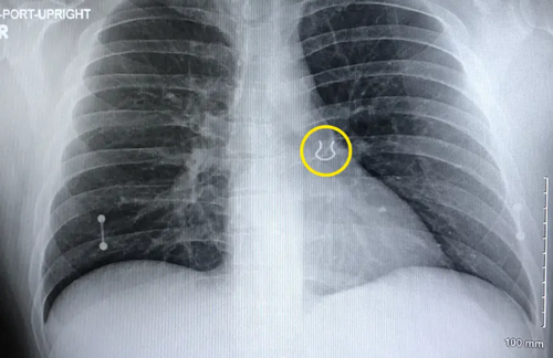 從腦袋里拔出了一雙筷子：你永遠(yuǎn)猜不到醫(yī)生能從患者身上找到什么