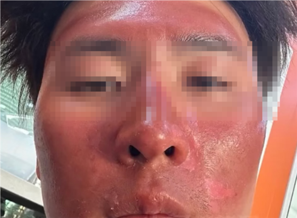 男子爬雪山曬傷成面膜臉：大面積流膿 脫皮