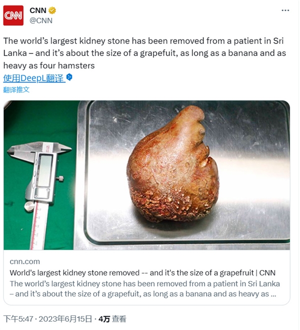 記得多喝水！世界最大腎結石出現：13厘米長、一斤半重